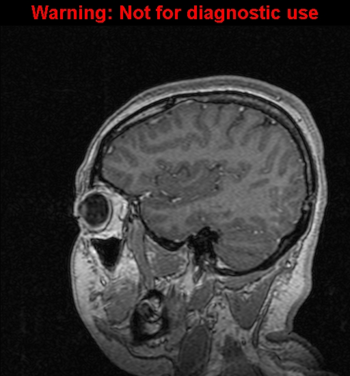 Cerebral venous thrombosis (Radiopaedia 37224-39208 Sagittal T1 C+ 39).jpg