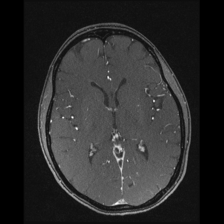 Cerebral venous thrombosis (Radiopaedia 45678-49854 Axial MRV 38).jpg