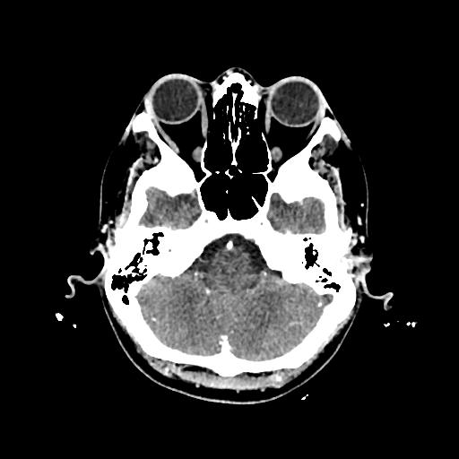 Cerebral venous thrombosis with venous hemorrhagic infarct (Radiopaedia 90354-107660 Axial with contrast 39).jpg
