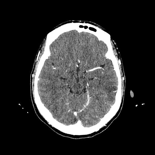 Cerebral venous thrombosis with venous hemorrhagic infarct (Radiopaedia 90354-107660 Axial with contrast 68).jpg