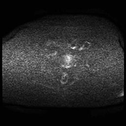File:Cervical carcinoma (Radiopaedia 70924-81132 Axial DWI 64).jpg
