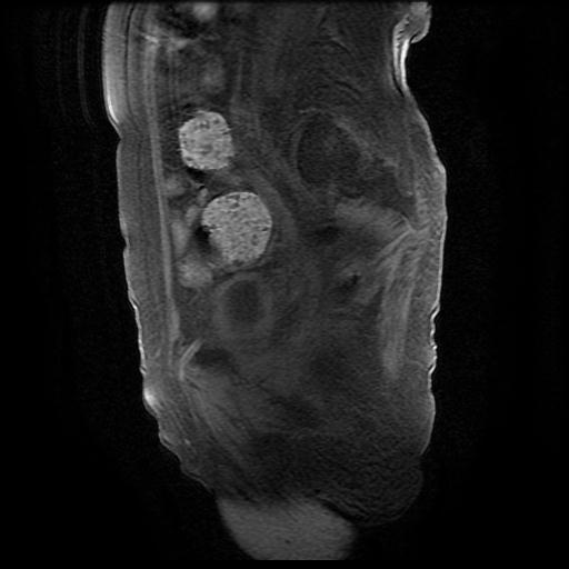 File:Cervical carcinoma (Radiopaedia 78847-91705 Sagittal T1 fat sat 12).jpg