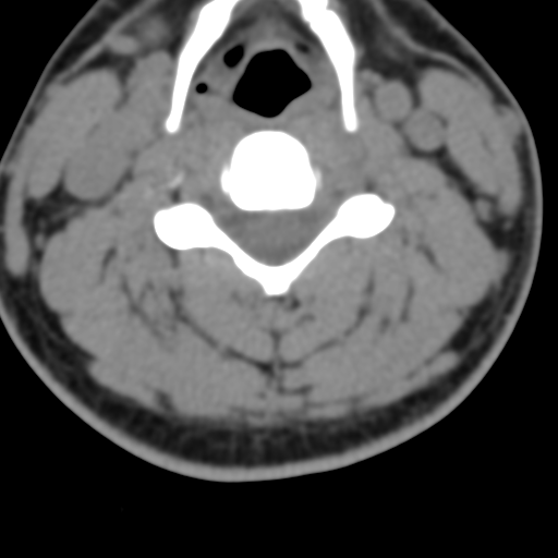 Cervical schwannoma (Radiopaedia 57979-64974 Axial non-contrast 33).png