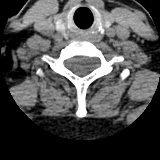 Cervical spinal neurofibroma in a patient with NF1 (Radiopaedia 58344-65464 Axial non-contrast 58).jpg