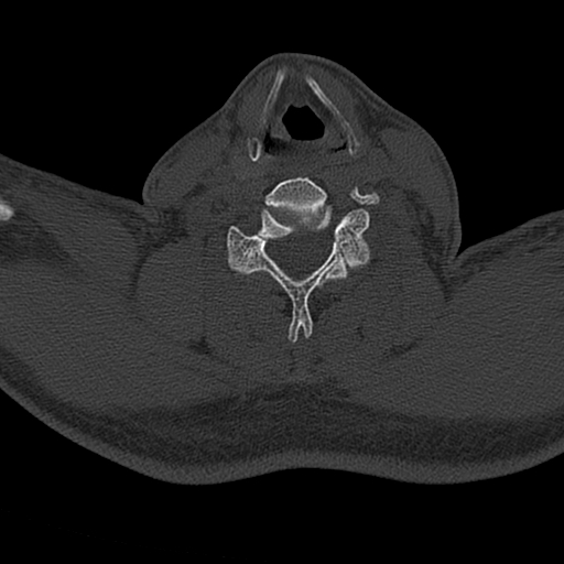 Cervical spine trauma with tear drop fracture and perched facet joint (Radiopaedia 53989-60127 Axial bone window 119).jpg