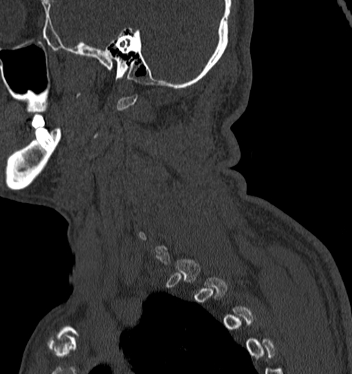 Cervical spine trauma with tear drop fracture and perched facet joint (Radiopaedia 53989-60127 Sagittal bone window 1).jpg