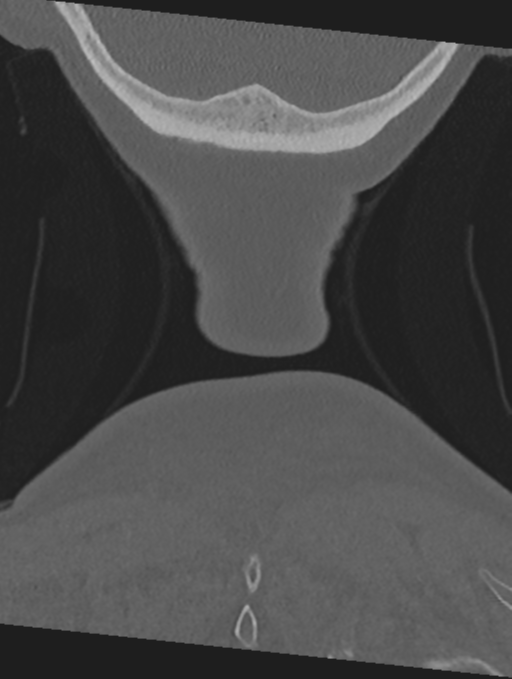 Cervical spondylolysis (Radiopaedia 49616-54811 Coronal bone window 70).png