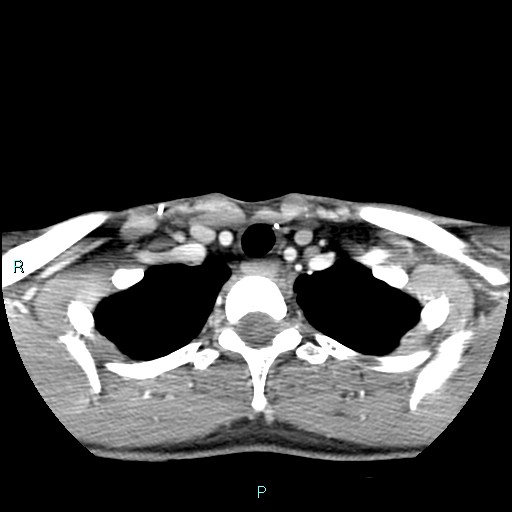 Cervical thymic cyst (Radiopaedia 88632-105335 B 29).jpg