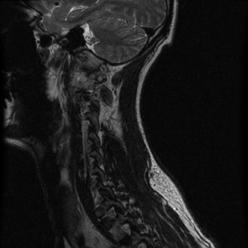 File:Cervical vertebrae metastasis (Radiopaedia 78814-91667 Sagittal T2 11).png