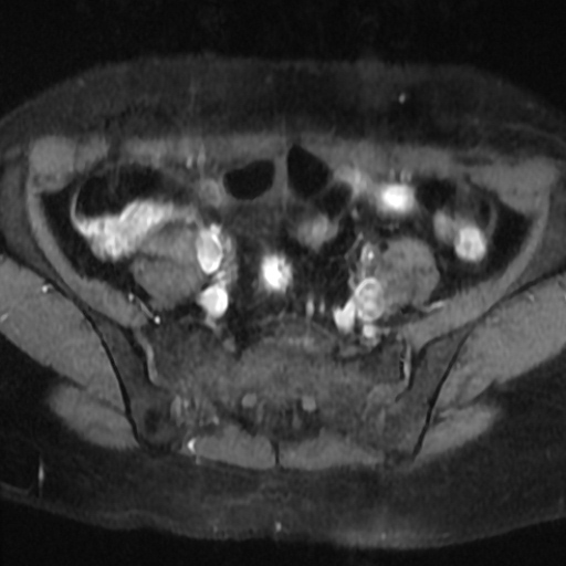 File:Cesarian section scar endometriosis (Radiopaedia 66520-75799 Axial T1 fat sat 3).jpg