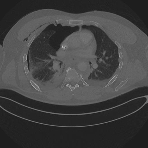 Chest multitrauma - aortic injury (Radiopaedia 34708-36147 Axial bone window 149).png