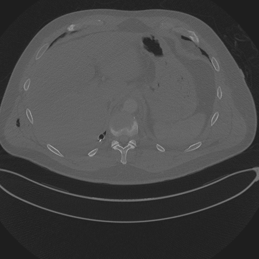 Chest multitrauma - aortic injury (Radiopaedia 34708-36147 Axial bone window 271).png
