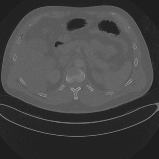 File:Chest multitrauma - aortic injury (Radiopaedia 34708-36147 Axial bone window 305).png