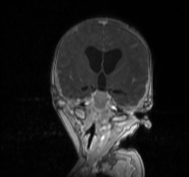 Chiari III malformation with occipital encephalocele (Radiopaedia 79446-92559 Coronal T1 C+ mpr 12).jpg