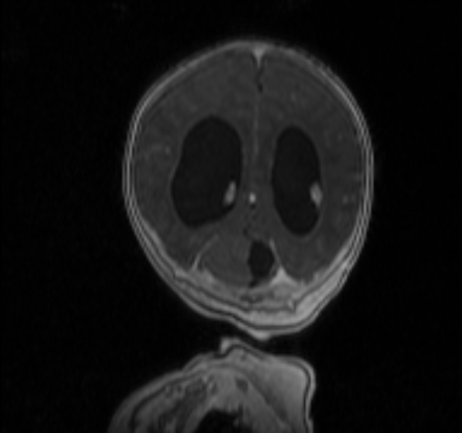 Chiari III malformation with occipital encephalocele (Radiopaedia 79446-92559 Coronal T1 C+ mpr 33).jpg