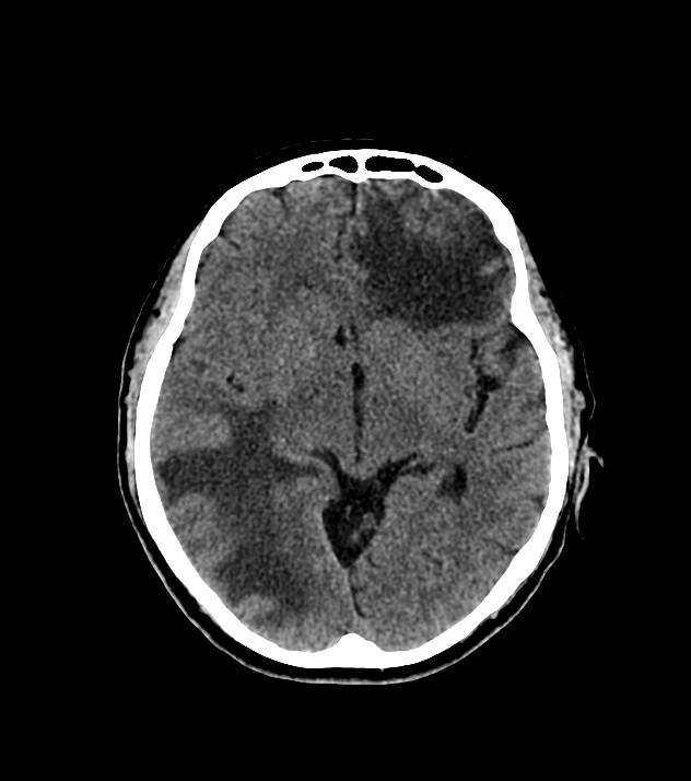 Cholangiocarcinoma with cerebral metastases (Radiopaedia 83519-98628 Axial non-contrast 33).jpg