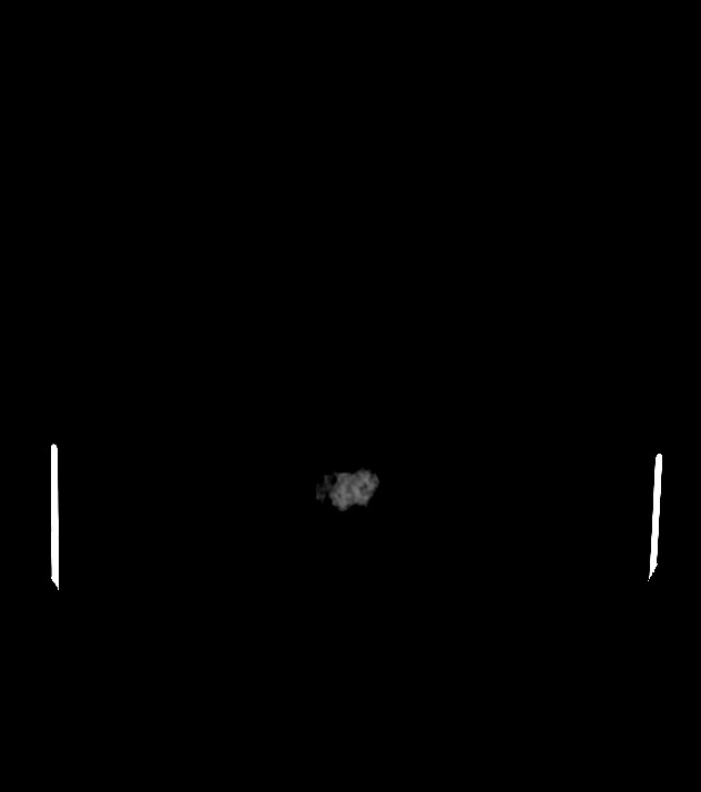 Cholangiocarcinoma with cerebral metastases (Radiopaedia 83519-98628 Axial non-contrast 68).jpg