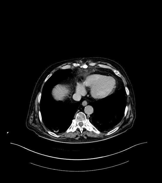 Cholangiocarcinoma with cerebral metastases (Radiopaedia 83519-98629 Axial C+ delayed 7).jpg