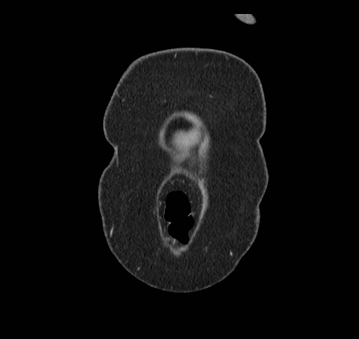 Cholecystoduodenal fistula (Radiopaedia 48959-54022 B 6).jpg