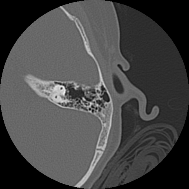 Cholesteatoma (Radiopaedia 73023-83750 Axial Left ear 62).jpg