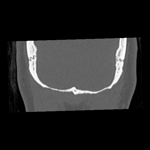 Cholesteatoma (Radiopaedia 84960-100474 Coronal bone window 79).jpg