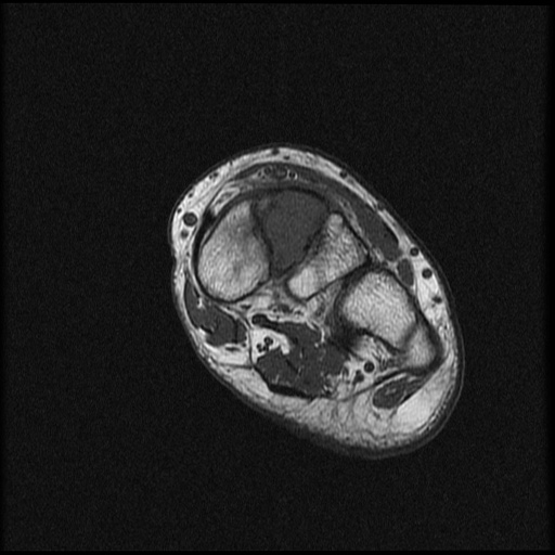 File:Chondroblastoma - midfoot (Radiopaedia 64831-73765 Short axis T1 14).jpg