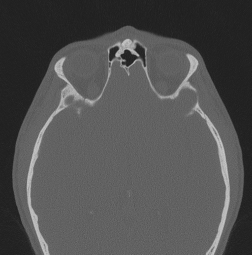 Chondrosarcoma (clivus) (Radiopaedia 46895-51425 Axial bone window 16).png