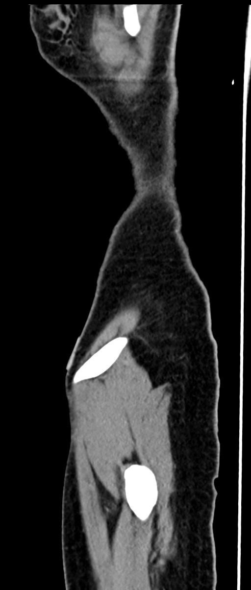 Choriocarcinoma liver metastases (Radiopaedia 74768-85766 C 36).jpg
