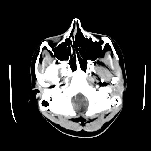 File:Choriocarcinoma of ovary with cerebral and pulmonary metastases (Radiopaedia 25983-26118 A 2).jpg