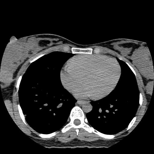 File:Choriocarcinoma of ovary with cerebral and pulmonary metastases (Radiopaedia 25983-26119 Axial non-contrast 2).jpg