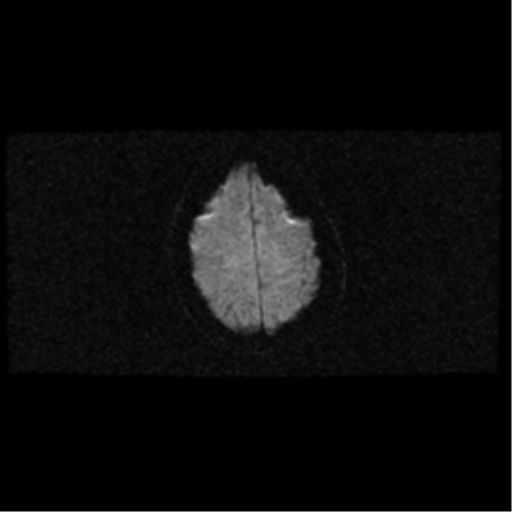 File:Choroid plexus papilloma (Radiopaedia 33040-34052 Axial DWI 16).png