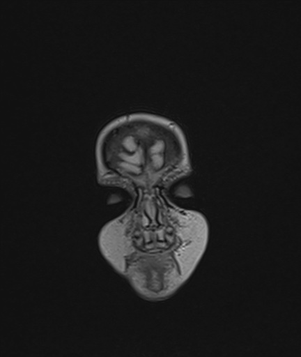 Choroid plexus papilloma (Radiopaedia 84612-100019 Coronal FLAIR 2).jpg