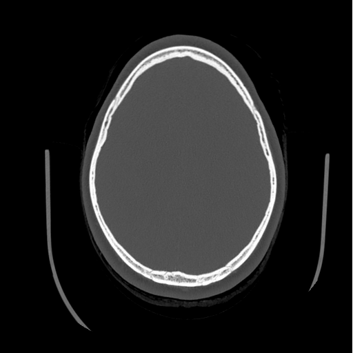 Choroid plexus papilloma extending into the cerebellopontine angle cistern (Radiopaedia 85941-101833 Axial bone window 68).png