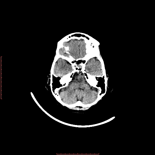 File:Choroid plexus xanthogranuloma (Radiopaedia 67843-77269 Axial non-contrast 13).jpg