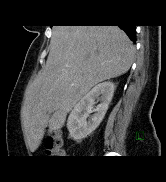 Chromophobe renal cell carcinoma (Radiopaedia 84239-99519 D 85).jpg