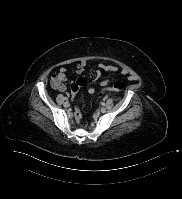 Chromophobe renal cell carcinoma (Radiopaedia 84239-99519 E 123).jpg