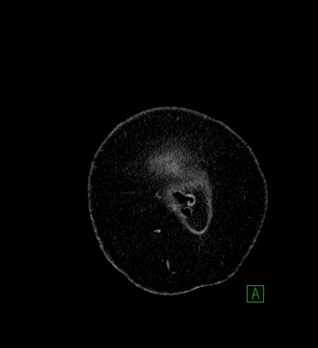 Chromophobe renal cell carcinoma (Radiopaedia 84239-99519 F 1).jpg