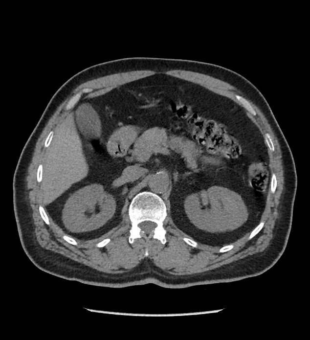 Chromophobe renal cell carcinoma (Radiopaedia 86879-103083 Axial non-contrast 28).jpg