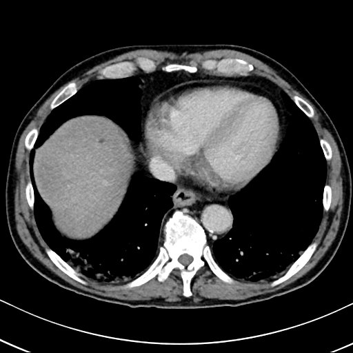 Chronic appendicitis complicated by appendicular abscess, pylephlebitis and liver abscess (Radiopaedia 54483-60700 B 21).jpg