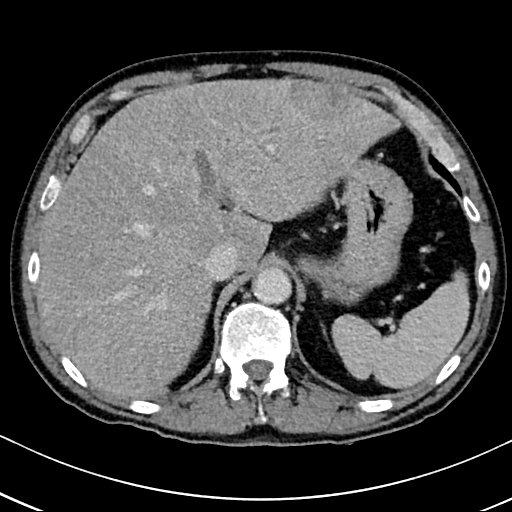 Chronic appendicitis complicated by appendicular abscess, pylephlebitis and liver abscess (Radiopaedia 54483-60700 B 40).jpg