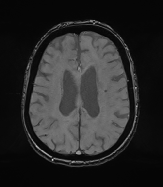 Chronic hypertensive encephalopathy (Radiopaedia 72844-83495 Axial SWI magnitude 57).png