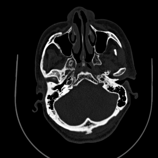 Chronic invasive fungal sinusitis (Radiopaedia 91563-109286 Axial sinus 27).jpg