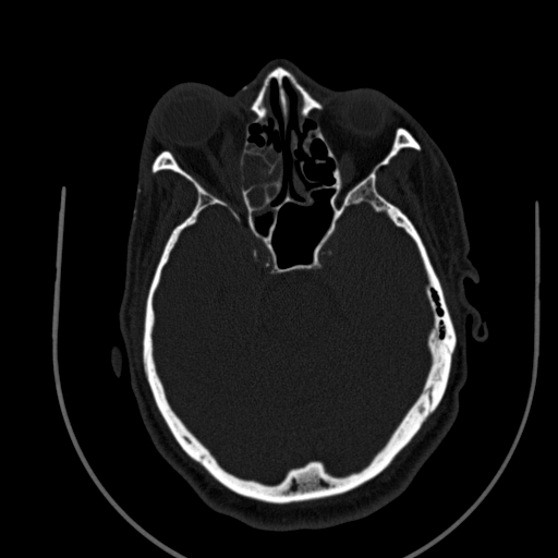 Chronic invasive fungal sinusitis (Radiopaedia 91563-109286 Axial sinus 75).jpg