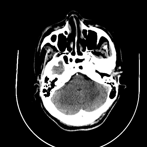 File:Chronic invasive fungal sinusitis (Radiopaedia 91563-109286 B 18).jpg