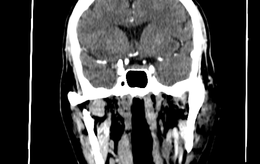 Chronic invasive fungal sinusitis (Radiopaedia 91563-109286 D 109).jpg