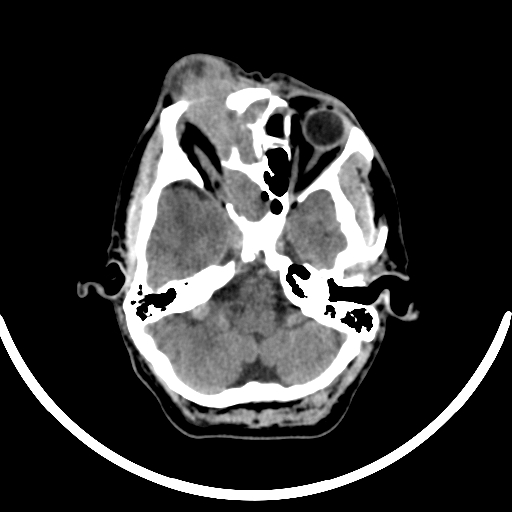 Chronic invasive fungal sinusitis with intraorbital and intracranial extension (Radiopaedia 56387-63046 Axial non-contrast 128).jpg