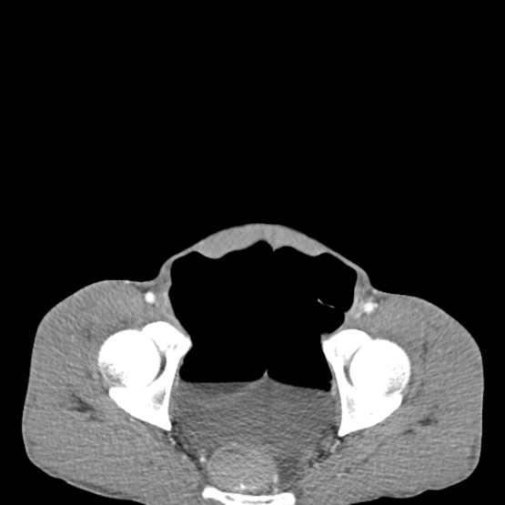 File:Chronic large bowel pseudo-obstruction (Radiopaedia 43181-46492 A 152).jpg