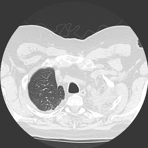 Chronic lung allograft dysfunction - restrictive form (Radiopaedia 60595-68316 Axial lung window 10).jpg