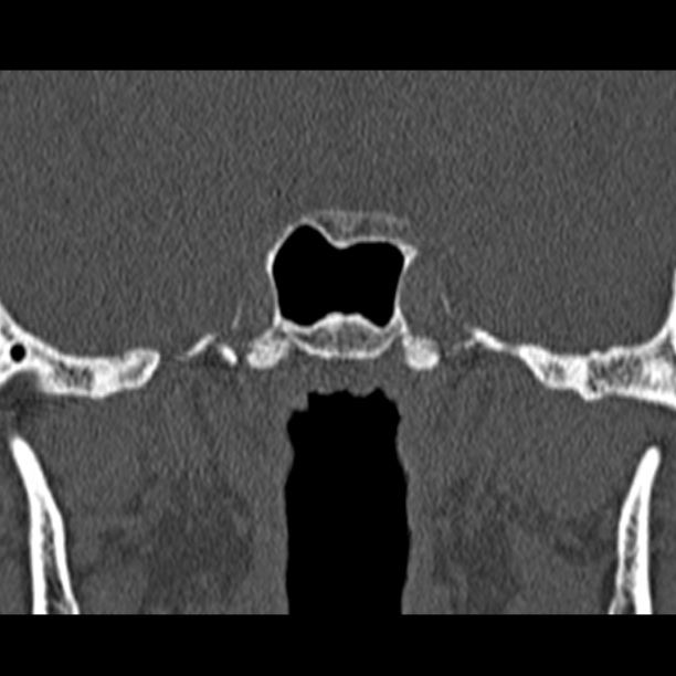Chronic maxillary sinusitis (Radiopaedia 27879-28116 Coronal bone window 54).jpg