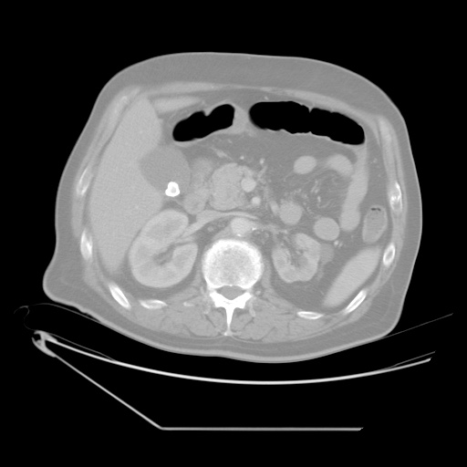 File:Chronic mesenteric ischemia - arterial (Radiopaedia 88205-104810 Axial lung window 3).jpg